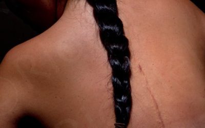 20 years since that fated spine surgery