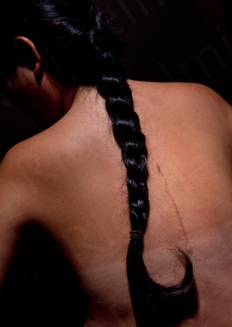 20 years since that fated spine surgery